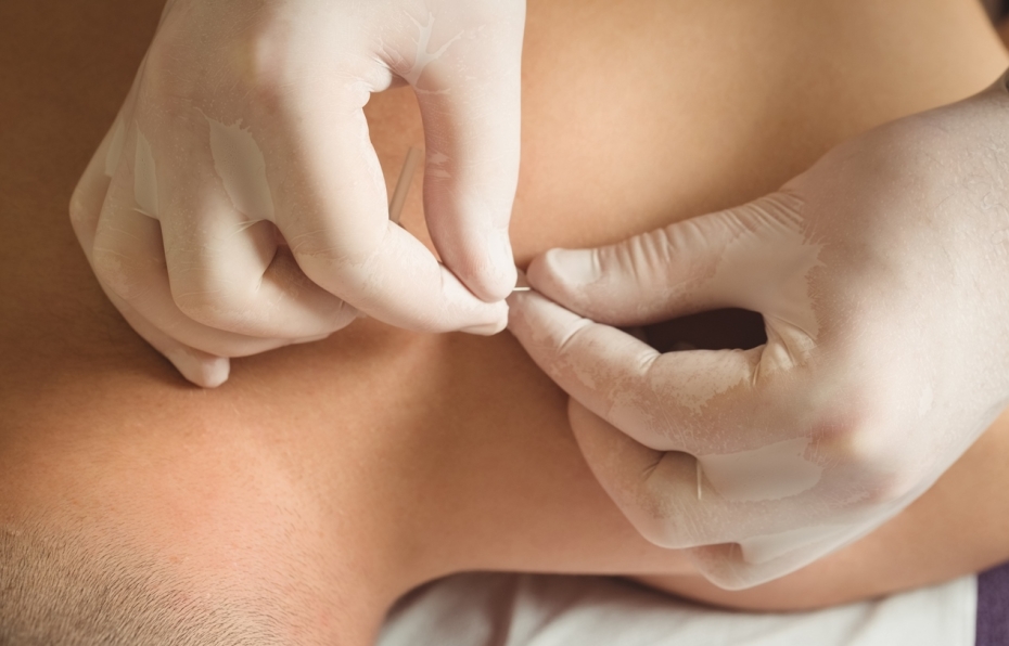 Close-up of Physiotherapist performing dry needling on patient